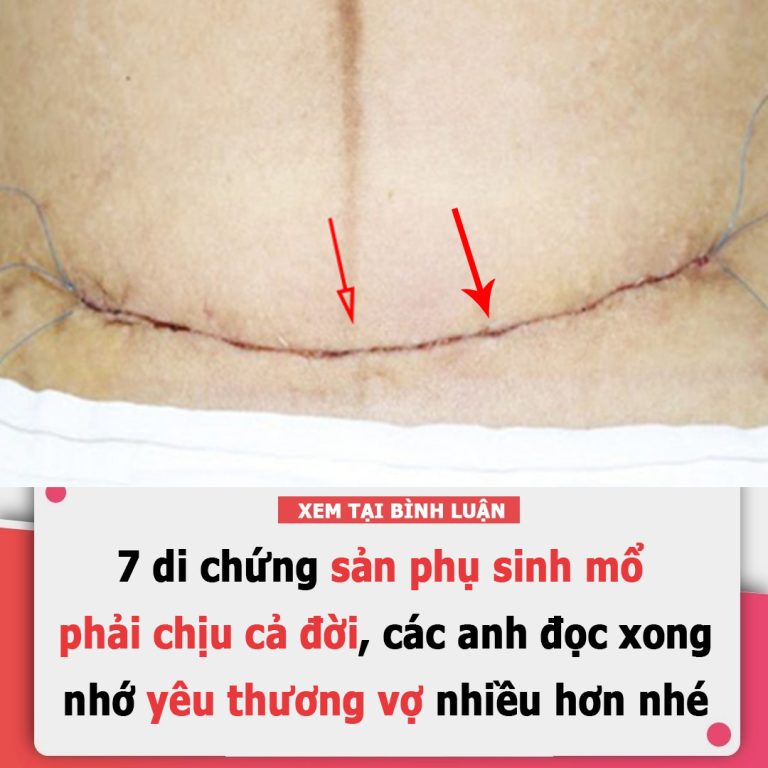 7 di chứng sản phụ sinh mổ phải chịu cả đời, chớ buông lời trách mẹ không thương con