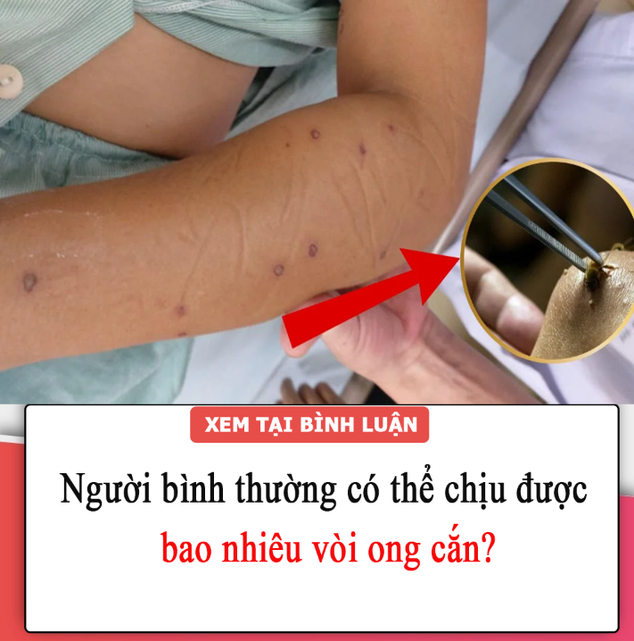 Người bình thường có thể chịu được bao nhiêu vòi ong cắn?