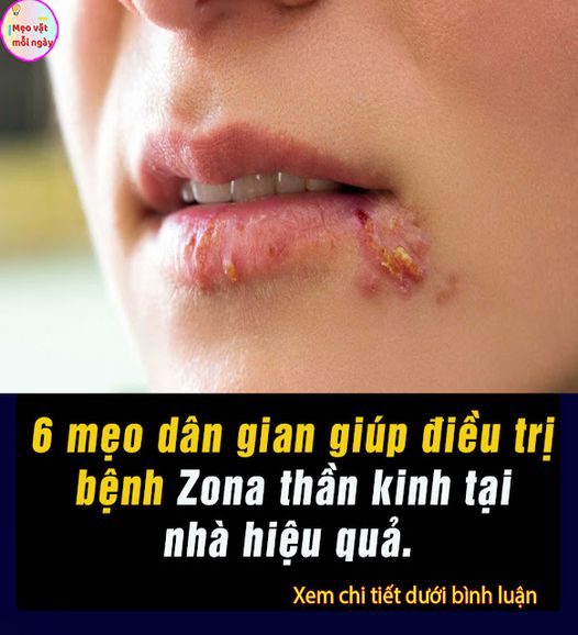 6 mẹo dân gian giúp điều trị b;ệnh Zo;na th;ần k;inh tại nhà hiệu quả.