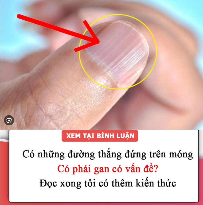 Có những đường thẳng đứng trên móng tay của tôi, chuyện gì xảy ra vậy? Có phải gan có vấn đề? Đọc xong tôi có thêm kiến thức