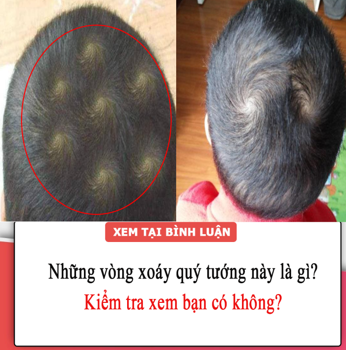 Người xưa nói dấu hiệu này trên người là những vòng xoáy quý tướng, đó là gì? Kiểm tra xem bạn có không?